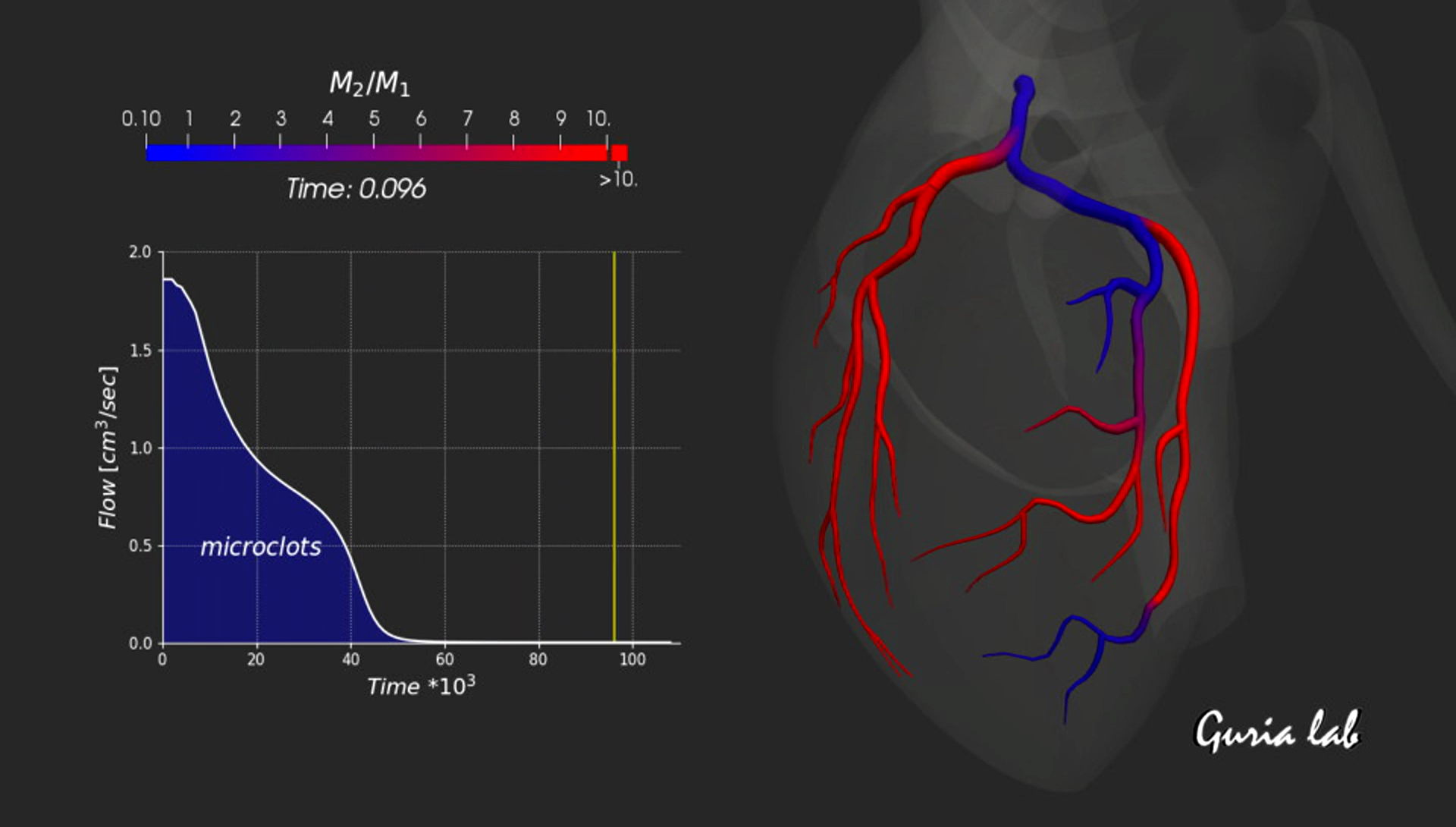 complete thrombosis of the coronary arteries